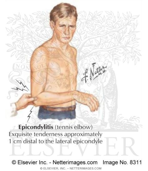 Watermarked preview of labeled image: Epicondylitis