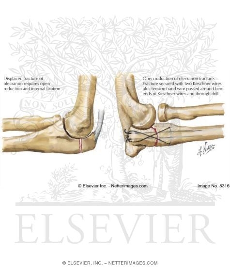 Olecranon Fracture