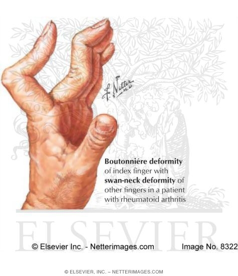 Boutonniere and Swan-neck Deformity