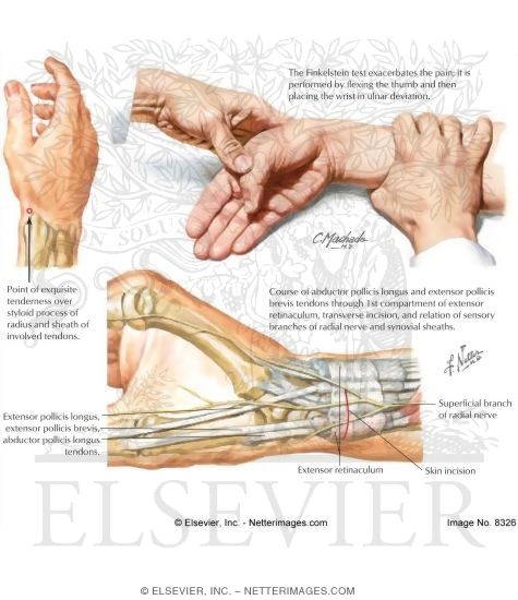 Heidemann Hand Und Ellenbogenchirurgie In Hurth Sehnenscheidenentzundungen Und Einengungen