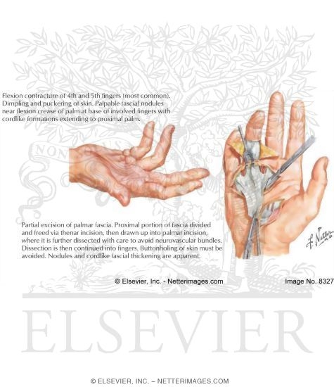 Dupuytren Disease