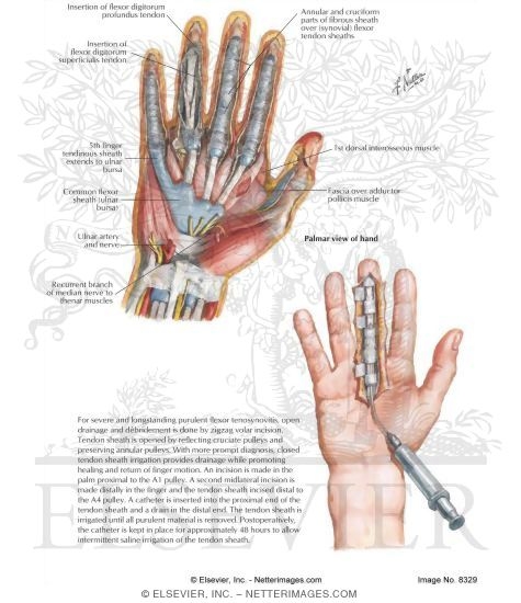 Watermarked preview of labeled image: Infections of the Hand