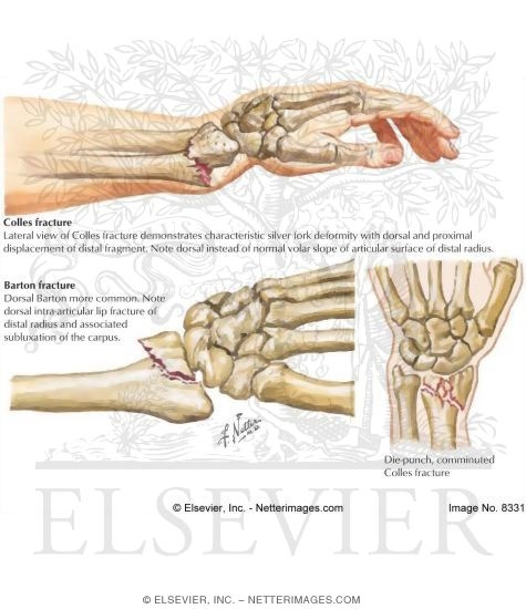 Fractures of the Distal Radius