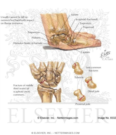 Fracture of Scaphoid