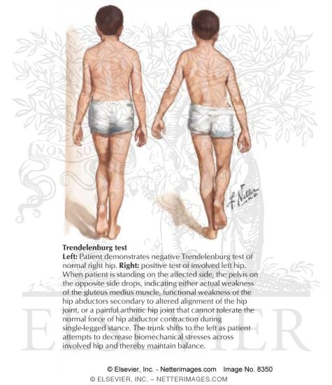 Trendelenberg Test