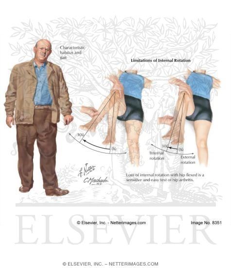 Watermarked preview of labeled image: Osteoarthritis of the Hip