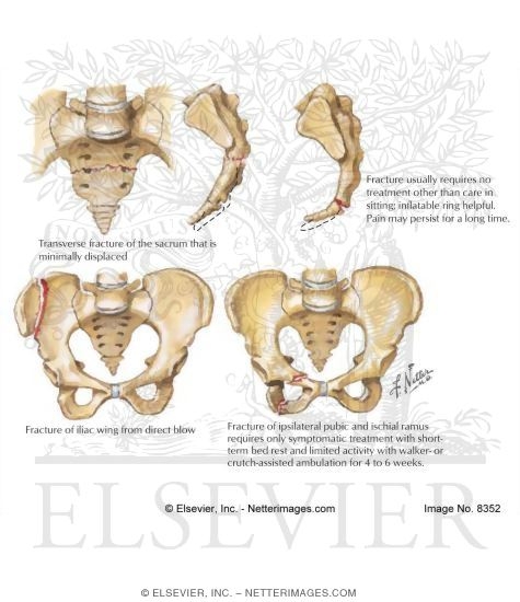 Watermarked preview of labeled image: Stable Pelvic Ring Fractures