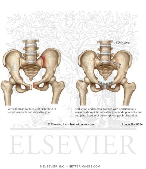 Internal Fixation for Type of Vertical Shear Fracture