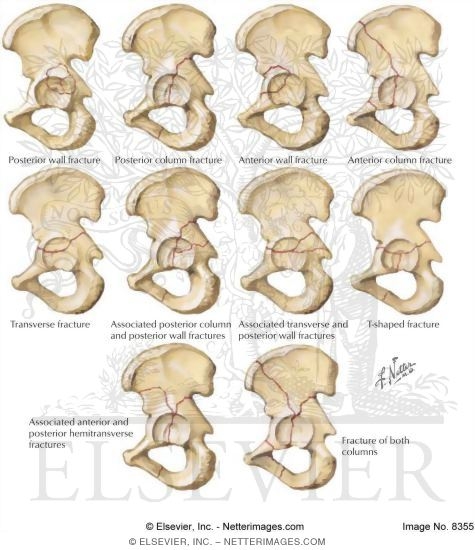 Watermarked preview of labeled image: Acetabular Fractures
