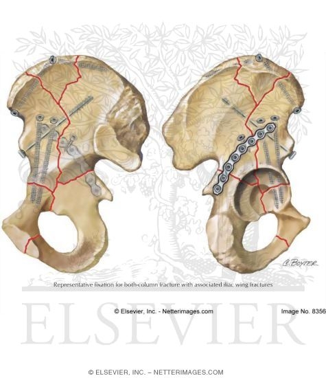 Watermarked preview of labeled image: Acetabular Fracture Fixation