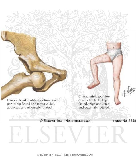 Watermarked preview of labeled image: Anterior Dislocation of Hip, Obturator Type