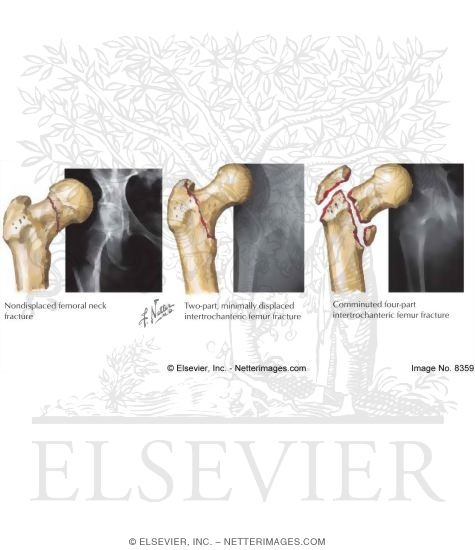 Watermarked preview of labeled image: Fracture of Femoral Neck and Intertrochanteric Fracture of Femur