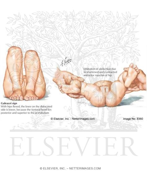 Watermarked preview of labeled image: Clinical Signs In Older Infant With Developmental Dysplasia of the Hip