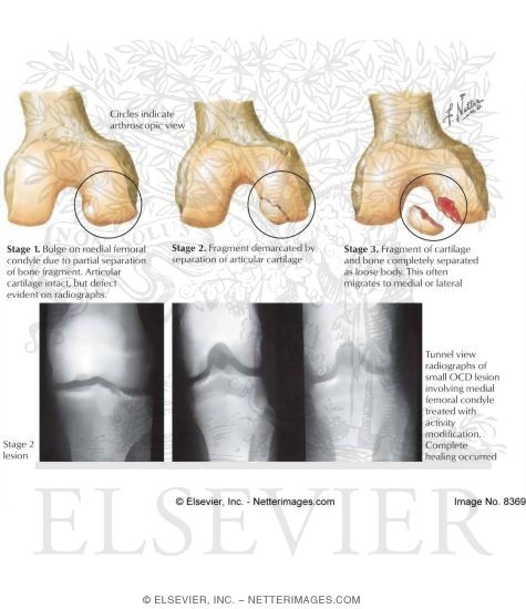 Watermarked preview of labeled image: Progression of Osteochondritis Dissecans