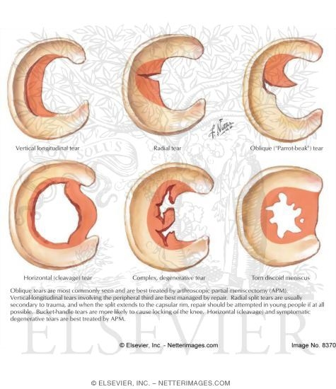 Types of Meniscal Tears
