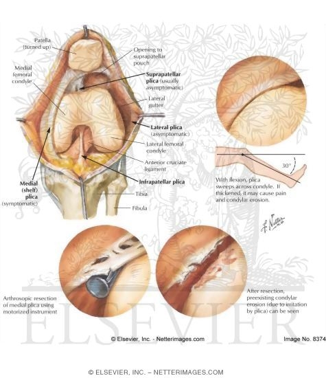 Watermarked preview of labeled image: Synovial Plica