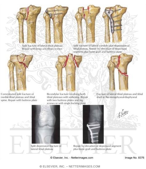 Watermarked preview of labeled image: Tibial Plateau Fractures