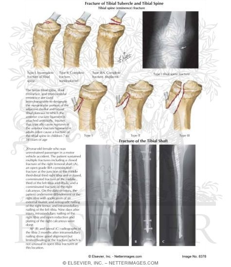 Watermarked preview of labeled image: Fracture of Tibial Tubercle, Tibial Spine, and Tibial Shaft