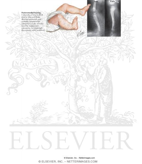 Posteromedial Bowing of the Tibia