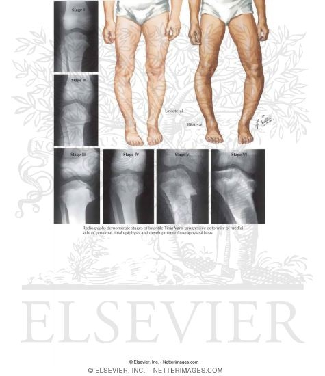 Watermarked preview of labeled image: Infantile Tibia Vara