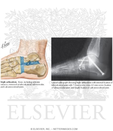 Watermarked preview of labeled image: Triple Arthrodesis