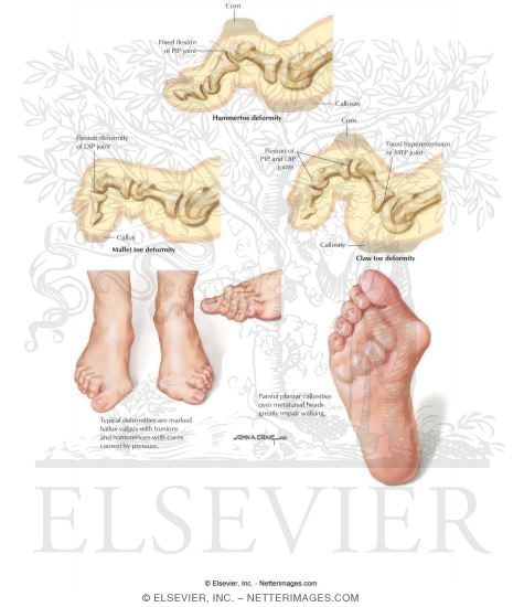 Lesser Toe Deformities (Claw Toe, Hammertoe, and Mallet Toe)
