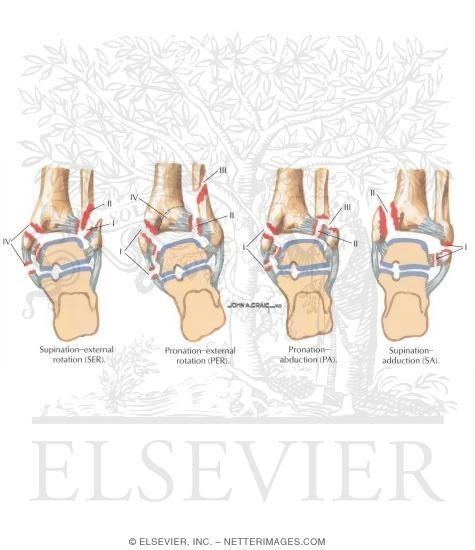 Lauge-Hansen Classification of Ankle Fracture