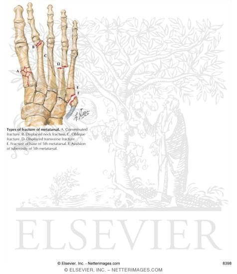 Injury to Metatarsals