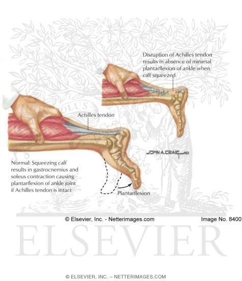 Thompson Test