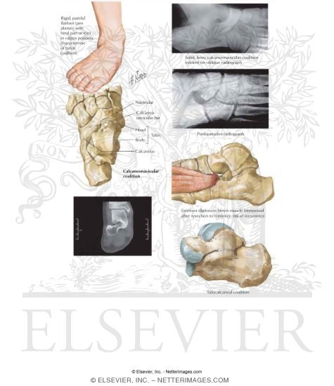 Watermarked preview of labeled image: Tarsal Coalition