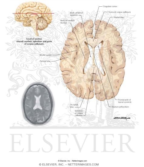 Basal Ganglia and Internal Capsule