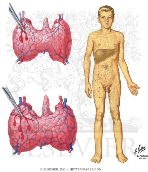 Thioamides: Adverse Effects