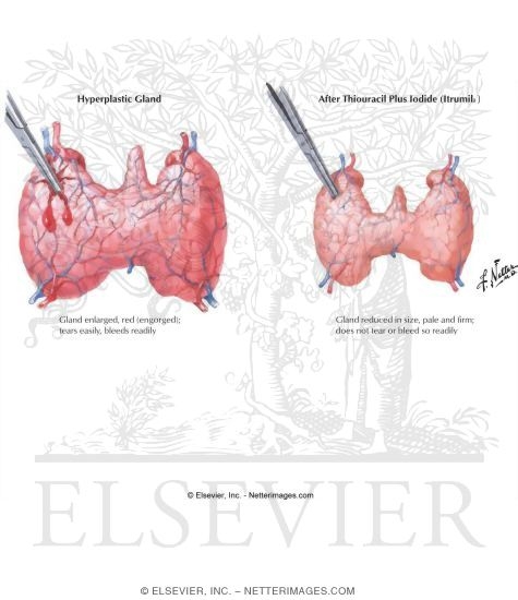 Watermarked preview of labeled image: Effects of Therapy in Diffuse Hyperthyroidism (Graves' Disease)