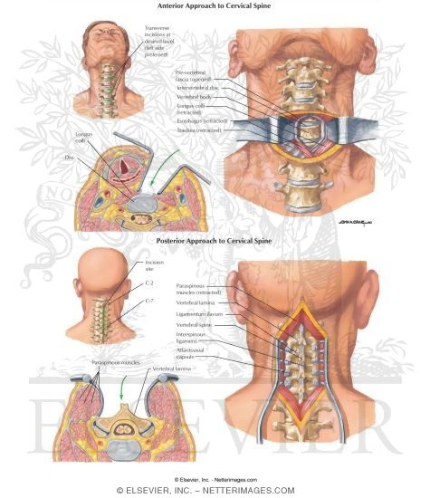 Anterior and Posterior Approach to Cervical Spine