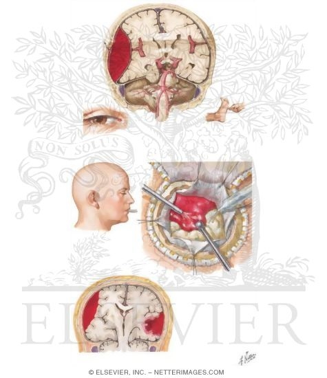 Watermarked preview of unlabeled image: Epidural Hematoma
