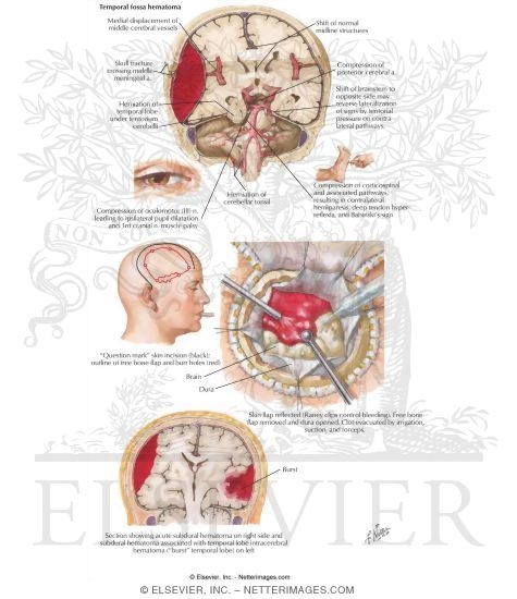 Epidural Hematoma
