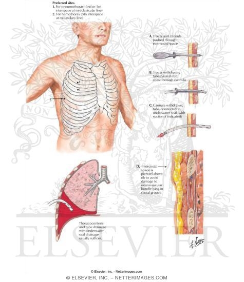 Chest Drainage Tube Placement