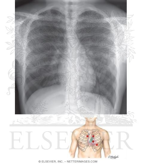 Radiograph of Chest