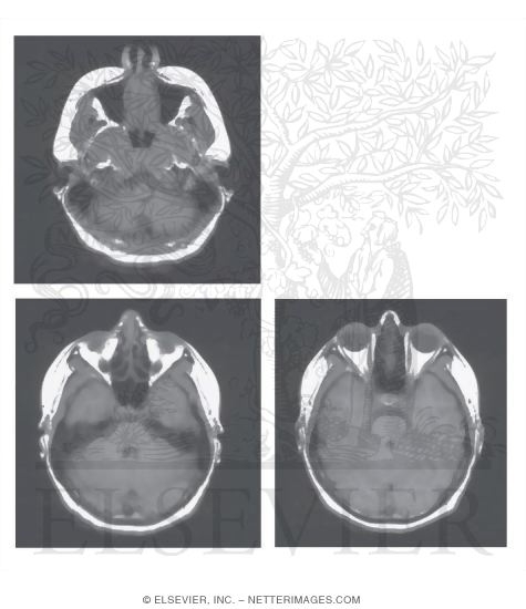 Head Scans: Axial CT Images