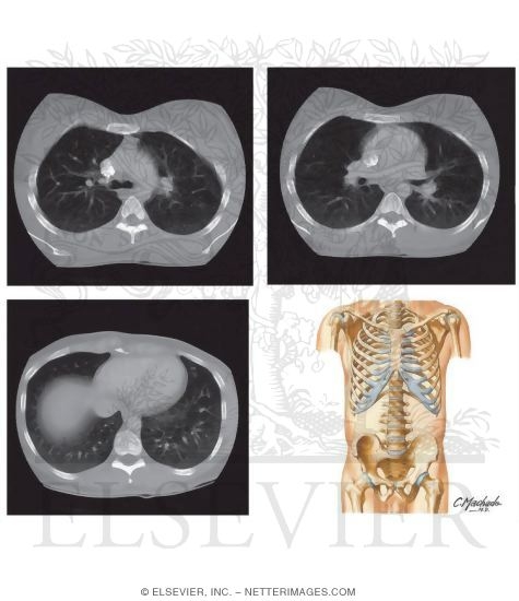 Chest Scans: Axial CT Images