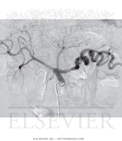 Watermarked preview of unlabeled image: Celiac Arteriogram