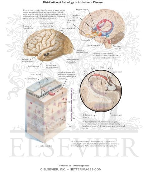 Watermarked preview of labeled image: Distribution of Pathology In Alzheimer's Disease
