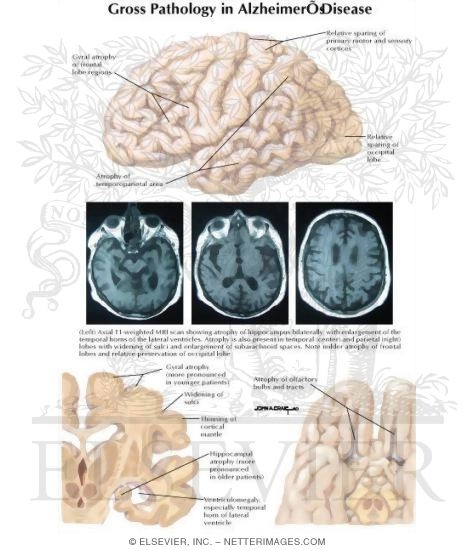 Watermarked preview of labeled image: Gross Pathology in Alzheimer's Disease