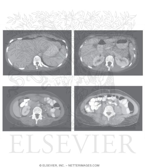 Abdominal Scans: Axial CT Images