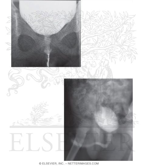 Male and Female Cystourethrograms