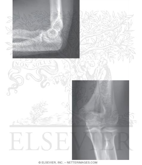 Watermarked preview of unlabeled image: Elbow: Radiographs