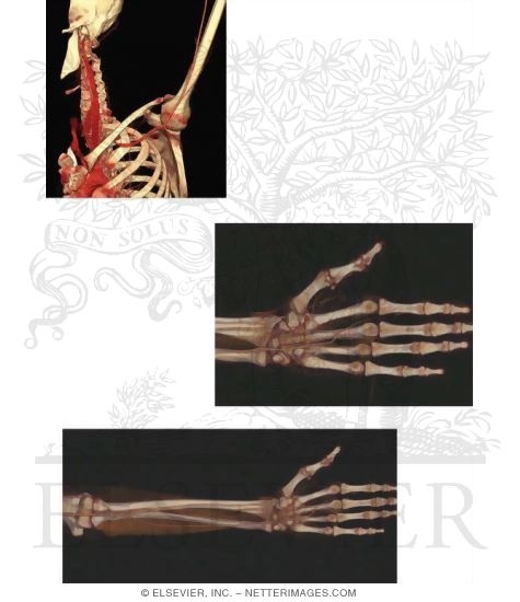CT Angiograms of Arteries of the Upper Limb