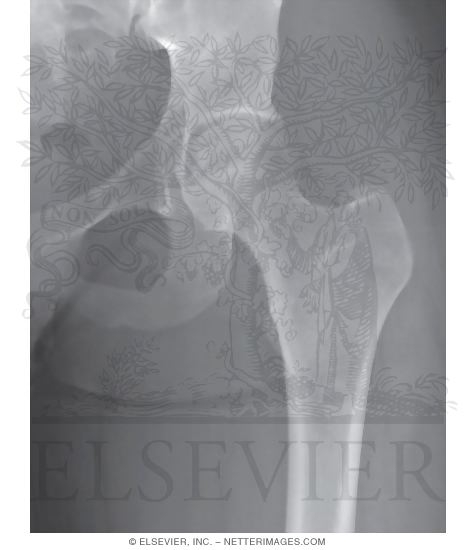 Hip Joint: Anteroposterior Radiograph