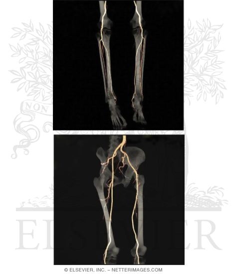 CT Angiograms of Arteries of the Lower Limb