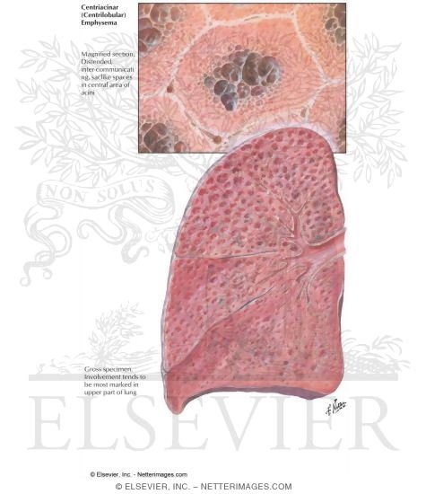 Centriacinar (Centrilobular) Emphysema